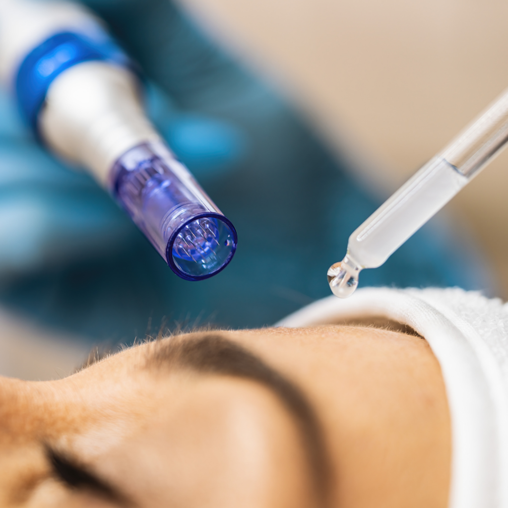 Microneedling mit dem Dermapen an der Stirn einer Kundin in der Beautylounge.
