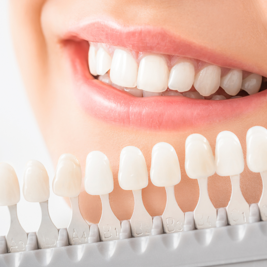 Zahnfarbskala vor einem L&auml;cheln beim kosmetischen Teeth Bleaching in der Beautylounge Basel.