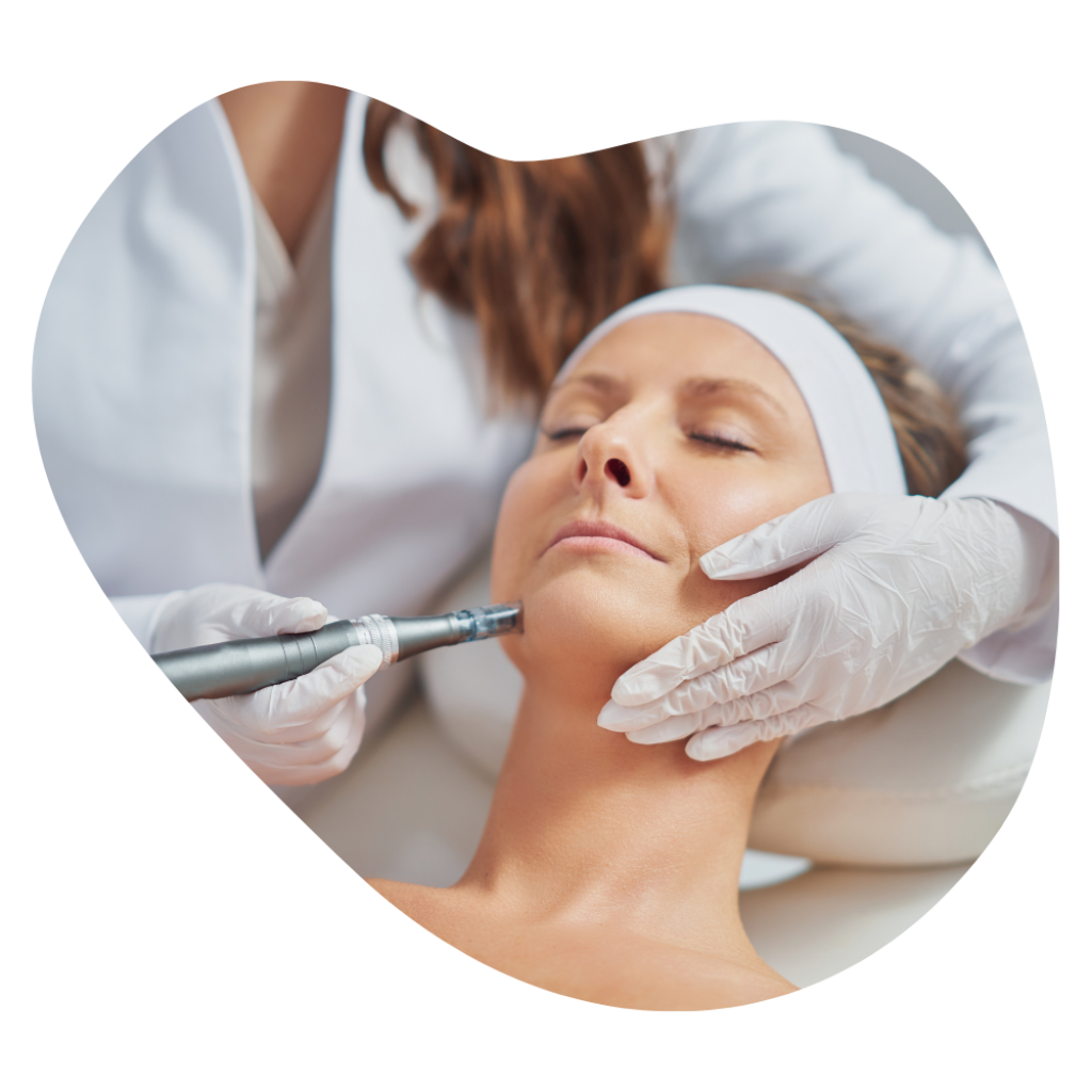 Microneedling-Behandlung am Kinn, feine Nadeln verbessern die Hautstruktur, f&ouml;rdern Kollagen und reduzieren Unreinheiten.